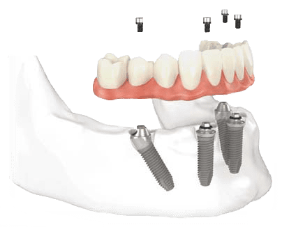 All on 4 Dental Implants
