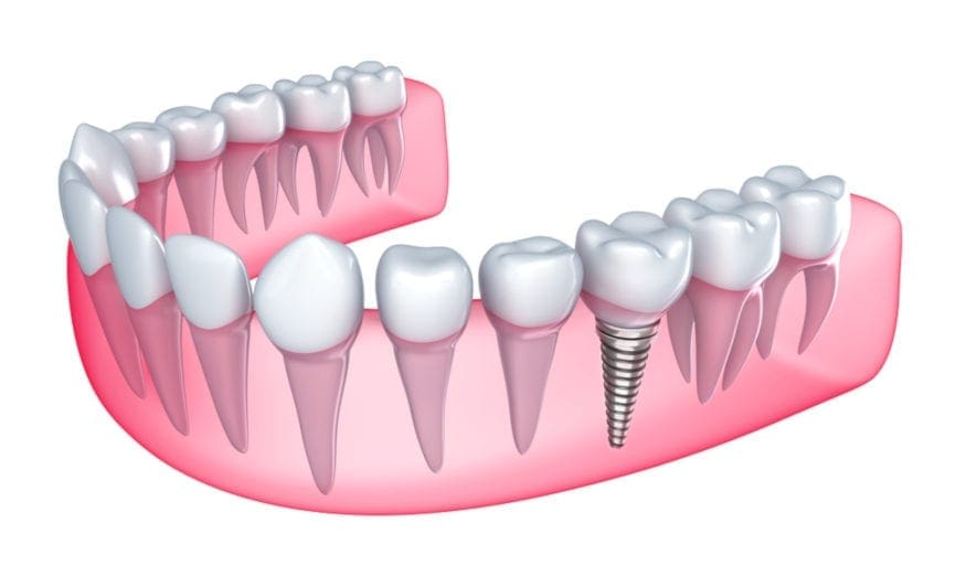 Dental Implants Dental Implants