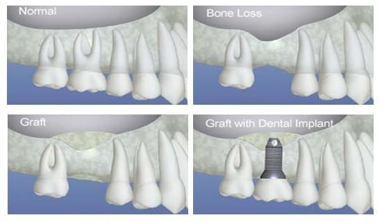 Bone Grafting Process Chart
