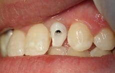 Dental Implants Dental Implants