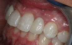 Dental Implants Dental Implants