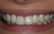 Dental Implants Dental Implants