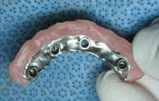 Dental Implants Dental Implants