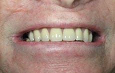 Dental Implants Dental Implants