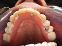 Dental Implants Dental Implants