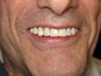 Dental Implants Dental Implants