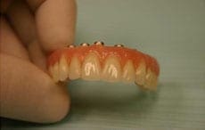 Dental Implants Dental Implants