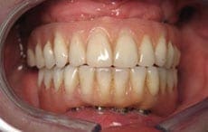 Dental Implants Dental Implants