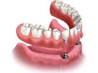 Dental Implants Graphic