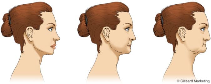 Bone Loss Graphic Bone Loss Graphic