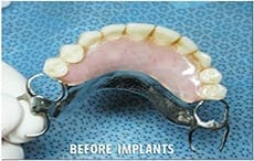 Dental Implants Dental Implants