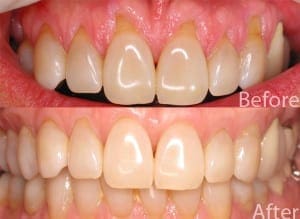 Regenerative Therapy Before and After Regenerative Therapy Before and After